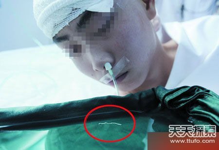 吃黄鳝吃出上百寄生虫 盘内蜷缩蠕动